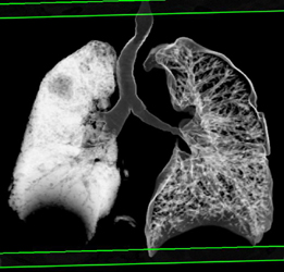 Stenosis of Left Mainstem Bronchus - CTisus CT Scan