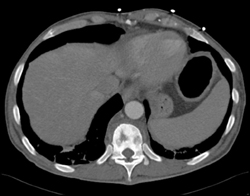 Chronic Osteomyelitis - CTisus CT Scan