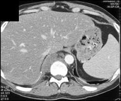 Subcrural Nodes - CTisus CT Scan