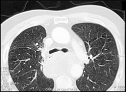 Esophageal Cancer Compressed the Airway - CTisus CT Scan