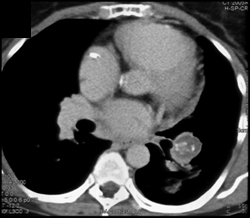 Chronic Pulmonary Artery Embolism in Left Main Pulmonary Artery - CTisus CT Scan