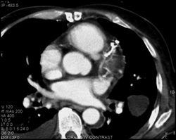 Pseudotumor - CTisus CT Scan