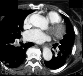 Pulmonary Embolism With Infarction - CTisus CT Scan