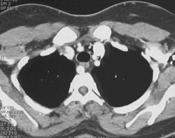 Abberant Right Subclavian Artery - CTisus CT Scan