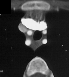 Right Aortic Arch With Mirror Branching and Almost A Duplicated Arch - CTisus CT Scan