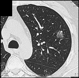 Bronchoalveolar Carcinoma (BAC) in Screening Patient - CTisus CT Scan