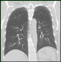 Right Lower Lung Nodule - CTisus CT Scan