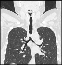 Tumor Invades the Trachea With Lumen Narrowing - CTisus CT Scan