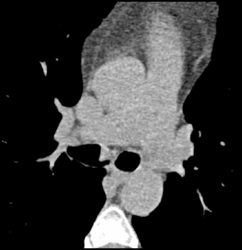 Carcinoid Tumor Right Mainstem Bronchus - CTisus CT Scan