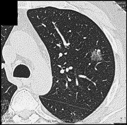 Bronchoalveolar Carcinoma (BAC) - CTisus CT Scan