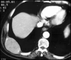 Plasmacytoma of Rib - CTisus CT Scan