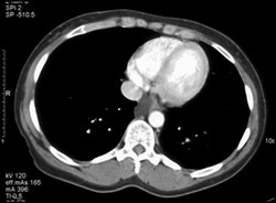 Bronchogenic Cyst - CTisus CT Scan