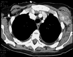 Tumor in Pectoralis Muscle - CTisus CT Scan