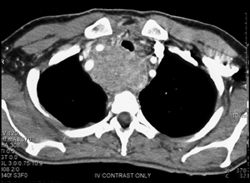 Thyroid Cancer Extends to Involve the Esophagus - CTisus CT Scan