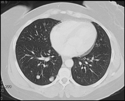 Lung Hamartoma - CTisus CT Scan