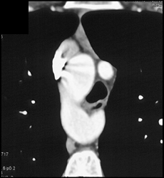 Right Aortic Arch With Interrupted Duplication of Arch - CTisus CT Scan