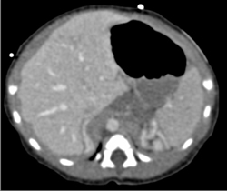 Extralobar Sequestration on the Left - CTisus CT Scan