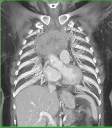 Thymoma - CTisus CT Scan