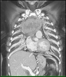 Thymoma - CTisus CT Scan