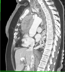 Thymoma - CTisus CT Scan