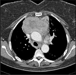 Thymoma - CTisus CT Scan