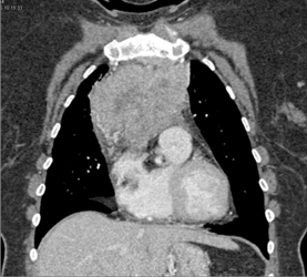 Thymoma - CTisus CT Scan