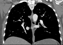 Pulmonary Embolism - CTisus CT Scan