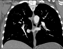 Pulmonary Embolism - CTisus CT Scan