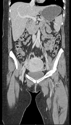 Left Deep Vein Thrombosis (DVT) Led to Pulmonary Embolism - CTisus CT Scan