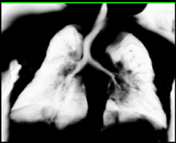 Ct Bronschoscopy With Narrowed Left Mainstem Bronchus - CTisus CT Scan