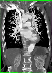 Focal Arch Pseudoaneurysm With Ulcer - CTisus CT Scan