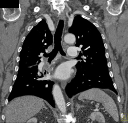 Carcinoid Right Lower Lobe - CTisus CT Scan