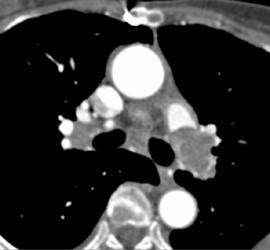 Tumor in Left Pulmonary Artery - CTisus CT Scan