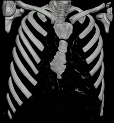 Pectus Deformity - CTisus CT Scan