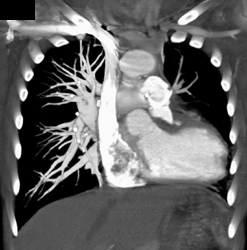 Relatively Poor Left Pulmonary Arterial Branching - CTisus CT Scan