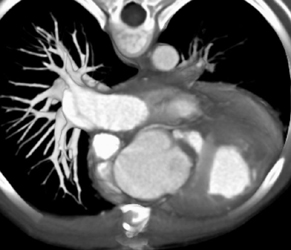 Dilated Aortic Root With Aberrant Coronary Artery - CTisus CT Scan