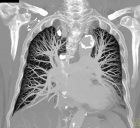 MIP of Pulmonary Tree - CTisus CT Scan