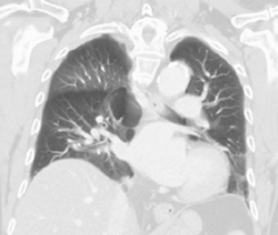 Inspiratory Vs Expiratory Lung Perfusion Changes - CTisus CT Scan