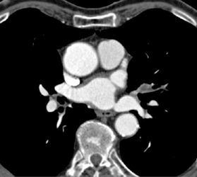 Tumor Along Vascular Tree - CTisus CT Scan