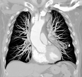 Left Lower Lobe Granuloma - CTisus CT Scan