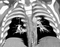 Bilateral Pulmonary Embolism - CTisus CT Scan