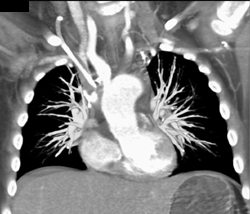 Pulmonary Embolism - CTisus CT Scan