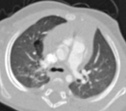 Atypical Cystic Adenomatoid Malformation - CTisus CT Scan