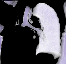 Occluded Right Mainstem Bronchus - CTisus CT Scan