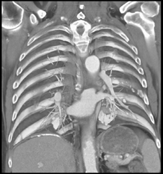 Asbestos Related Pleural and Diaphragmatic Disease With Plaques - CTisus CT Scan