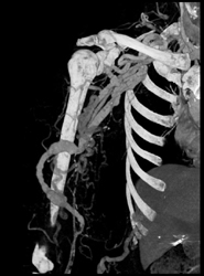 Arteriovenous (AV) Fistulae - CTisus CT Scan