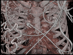 Dilated Azygos Vein - CTisus CT Scan