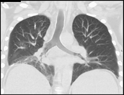 Mass in Right Lower Lobe Bronchus - CTisus CT Scan