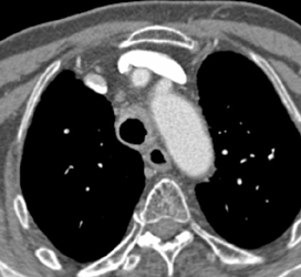 Cancer of the Esophagus Involves the Trachea With A Stent in Place - CTisus CT Scan