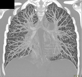 Small Pulmonary Arteriovenous (AV) Fistulae - CTisus CT Scan